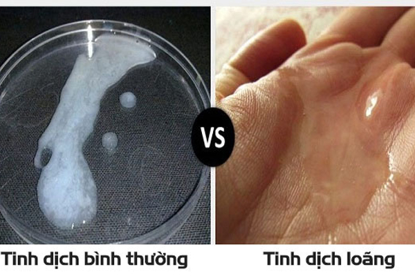 Tinh trùng loãng gây ảnh hưởng tới sức khỏe sinh sản của nam giới Tinh trùng loãng gây ảnh hưởng tới sức khỏe sinh sản của nam giới