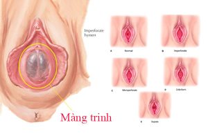 Màng trinh là cơ quan nằm bên trong âm đạo 