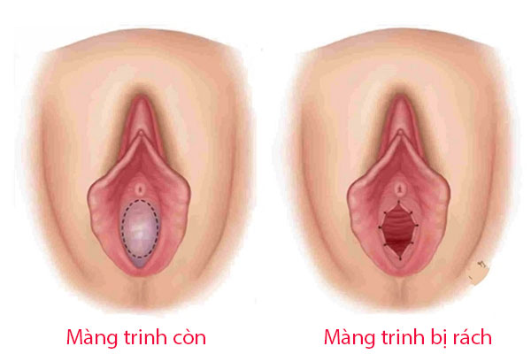 Có thể nhận diện màng trinh bằng mắt trường Có thể nhận diện màng trinh bằng mắt trường