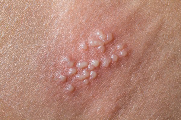 Dương vật nổi mụn có thể là biểu hiện của bệnh lý như mụn cóc sinh dục