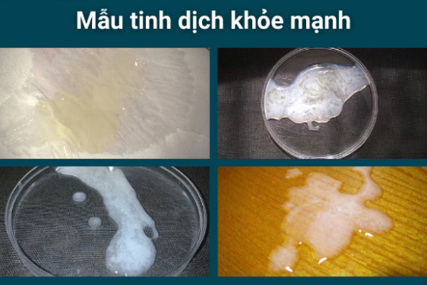 Tinh trùng khỏe mạnh thường có màu trắng đục và mùi vị không quá khó chịu Tinh trùng khỏe mạnh thường có màu trắng đục và mùi vị không quá khó chịu