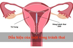 8 Dấu hiệu nhận biết khi tuột vòng tránh thai là những biểu hiện chị em cần nắm vững.