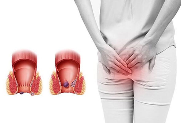 Việc lạm dụng quan hệ qua hậu môn với tần suất nhiều có thể dẫn đến bệnh trĩ.